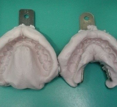Two dental stone casts of upper and lower jaws with metal mounting plates, used in prosthodontics for denture fabrication.