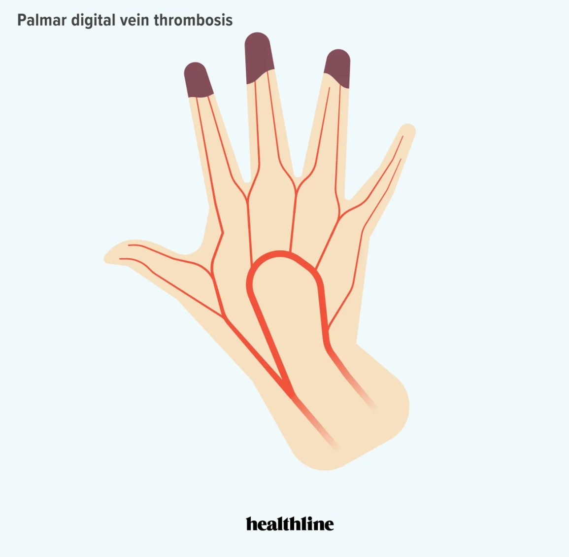 Illustration of palmar digital vein thrombosis showing dark discoloration on fingertips and red vein network in the hand.