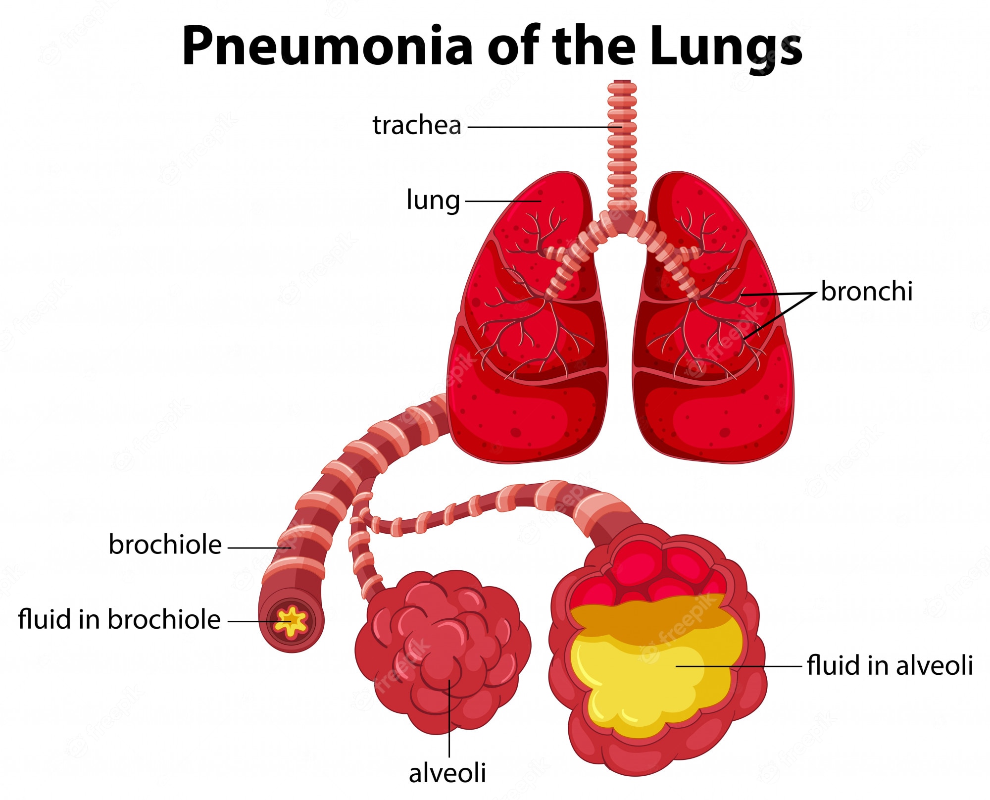 pneumonia - Stock Illustration [25838924] - PIXTA - Clip Art Library