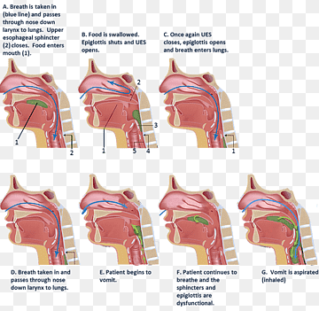 Aspiration Process Diagram: How Food or Vomit Enters the Lungs