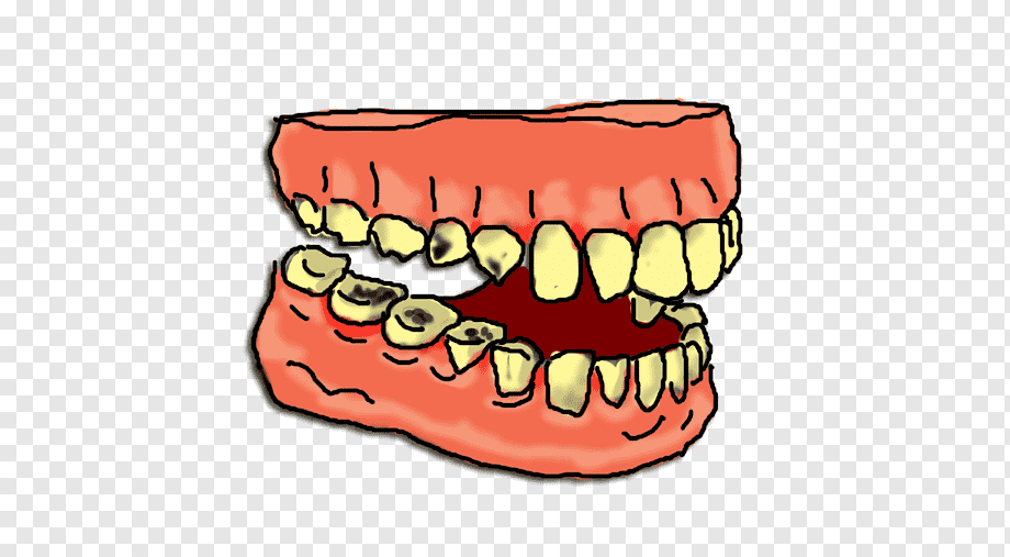 Illustrated open mouth showing severe tooth decay, gum disease, and yellowed teeth on a transparent background.