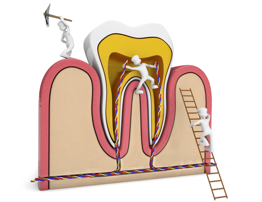 Animated 3D illustration of miniature workers repairing a tooth’s root canal with tools and wiring.