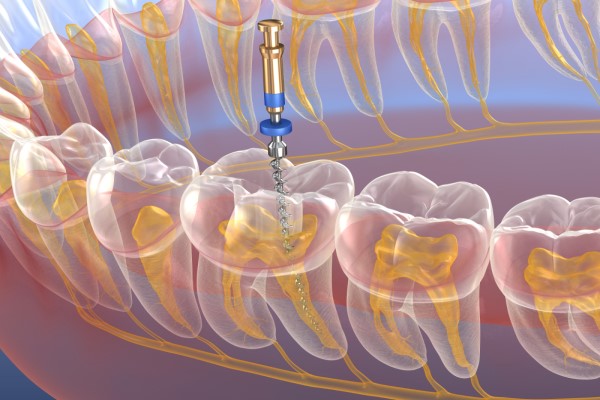 Dental implant being placed into the jawbone with surrounding teeth and gum tissue shown in cross-section.