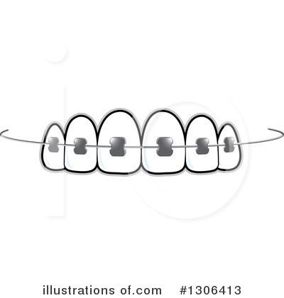 Illustration of upper teeth with traditional metal braces and archwire.
