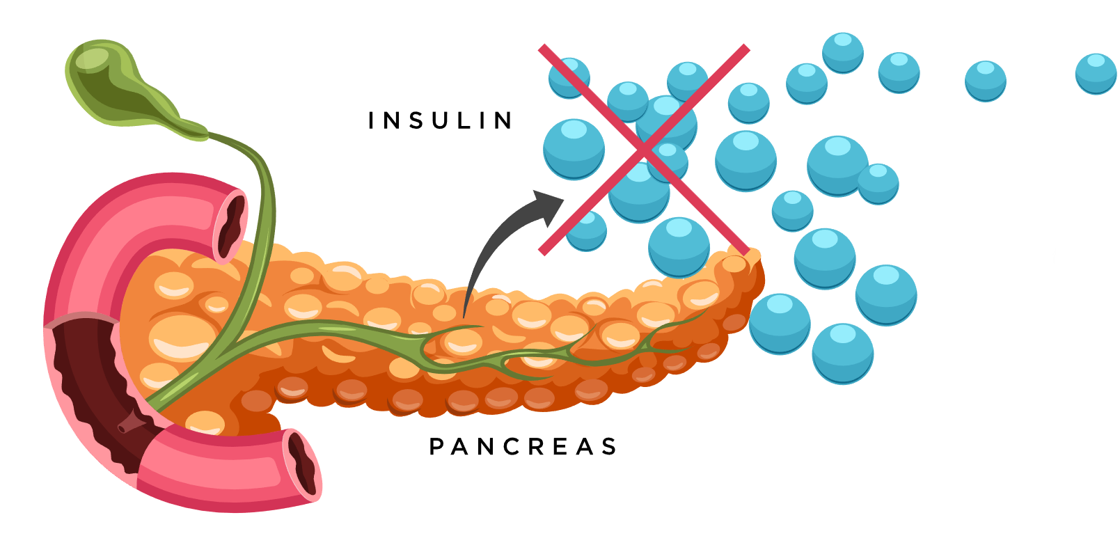 Hyperglycemia Stock Vector Illustration And Royalty Free Clip Art Library