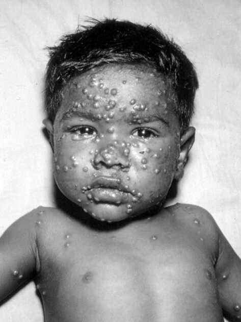 Child with severe smallpox rash showing pustular lesions on face and torso, historical black-and-white medical photograph.