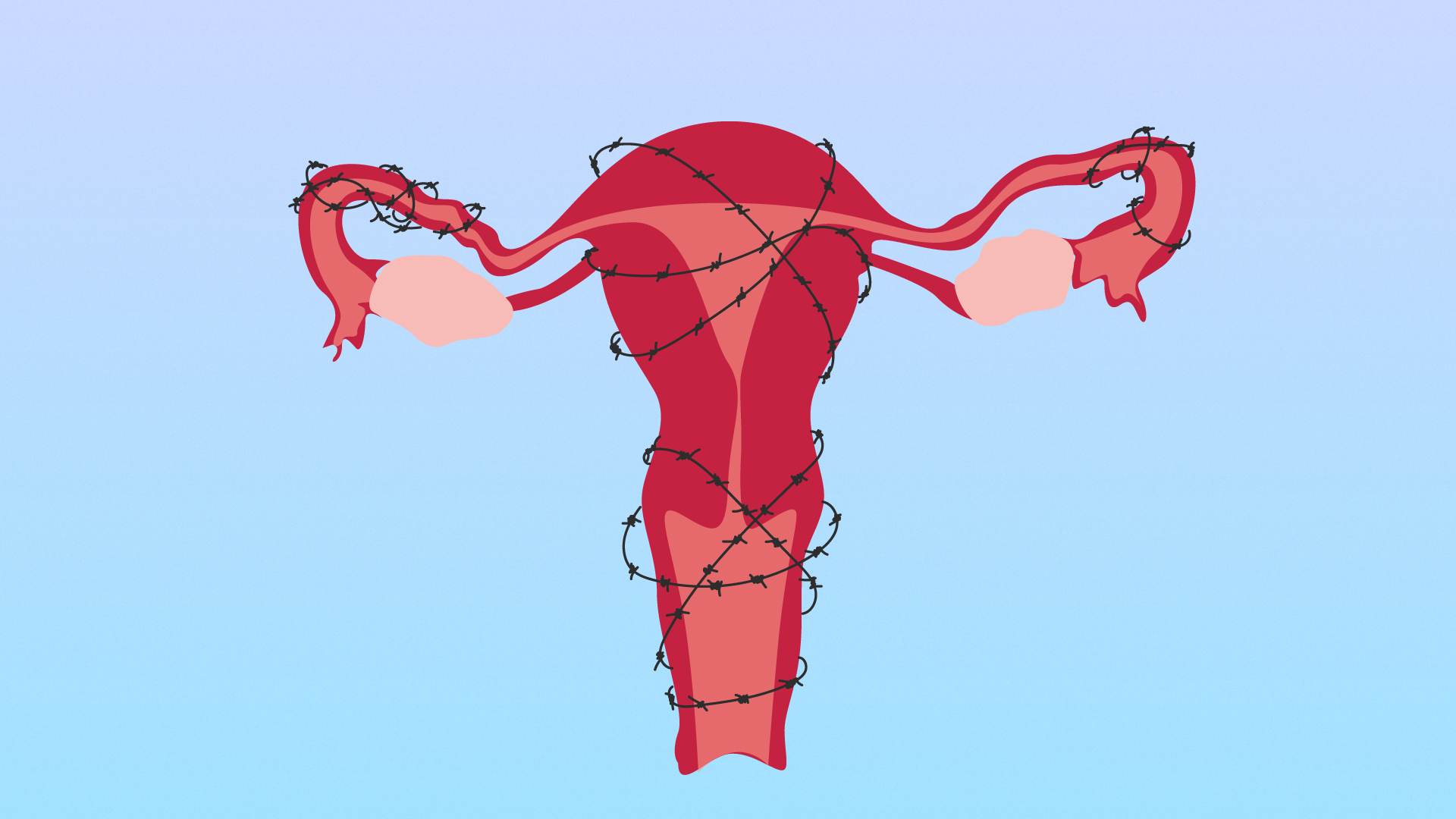 48 Endometriosis High Res Illustrations - Getty Images