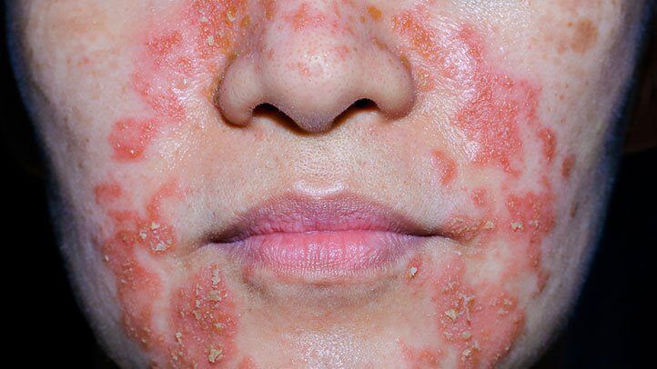 Close-up of a person's face showing red, inflamed, scaly patches consistent with severe seborrheic dermatitis or psoriasis.