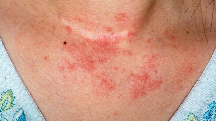 Red, inflamed skin rash with small papules and patches on the neck and upper chest area.