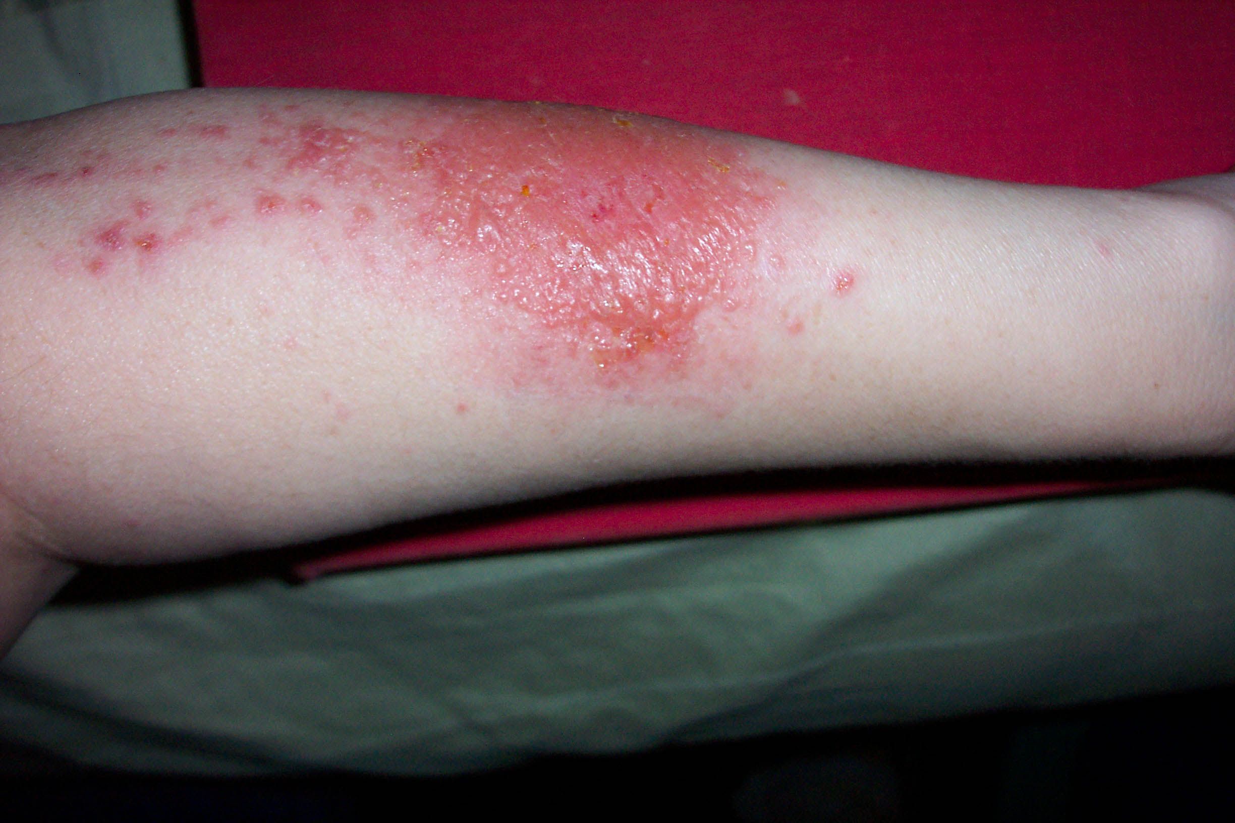 Another Word Skin Rash