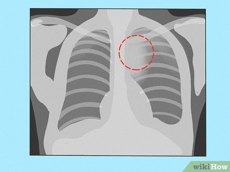 Chest X-ray showing lungs with a red circle highlighting a suspected pulmonary lesion or mass in the right upper lobe.