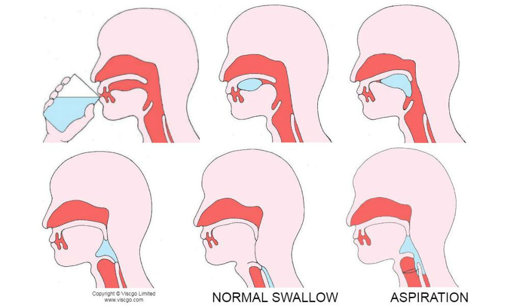 Dysphagia Stock Illustration 9876714 PIXTA Clip Art Library Dysphagia Stock Illustration 9876714 PIXTA Clip Art Library