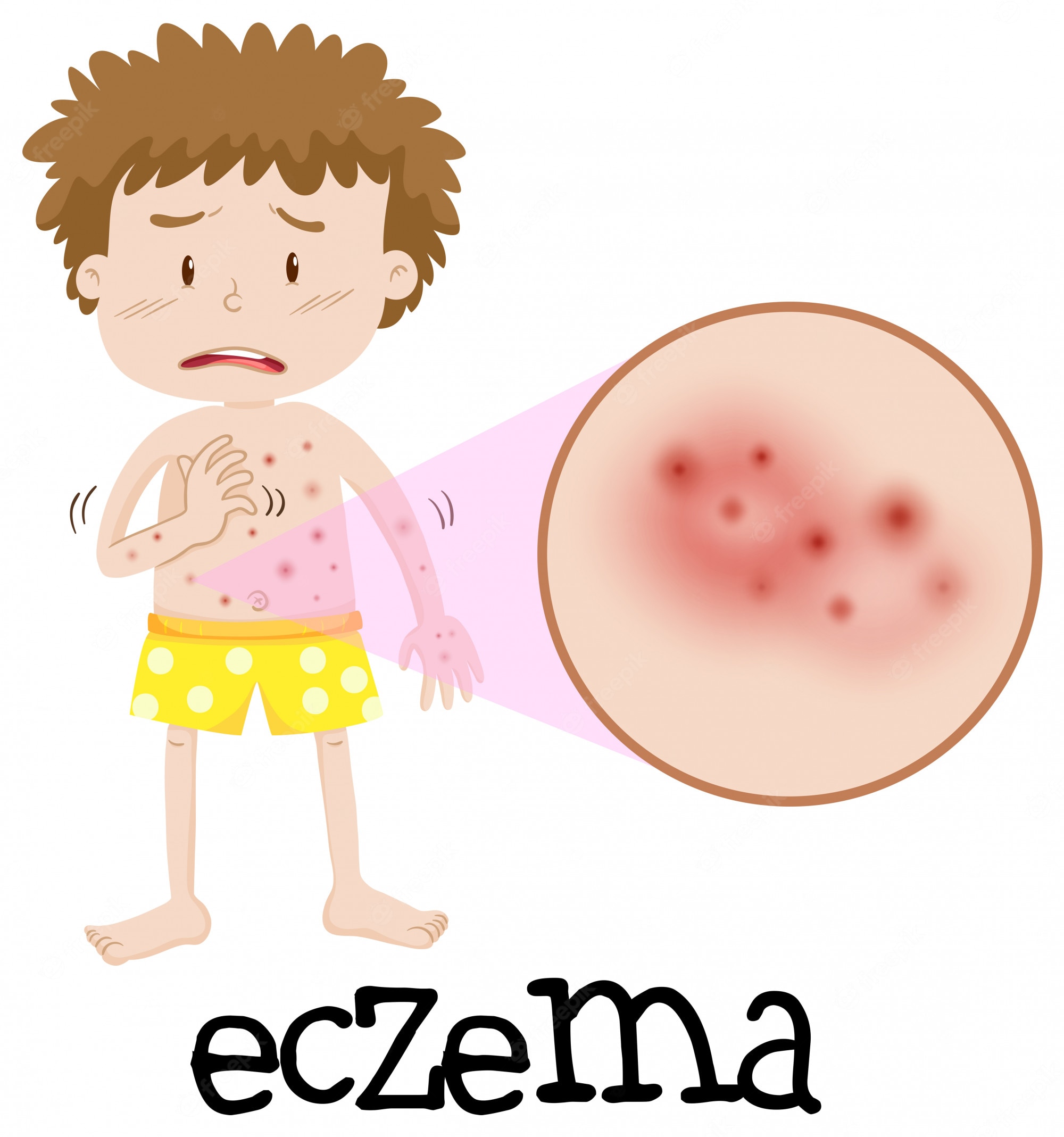 eczemas - Clip Art Library