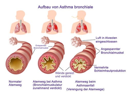 ᐅ Asthma Bronchiale • Ursachen, Symptome und Behandlung