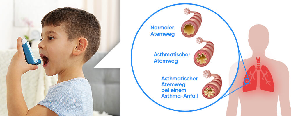 asthmas