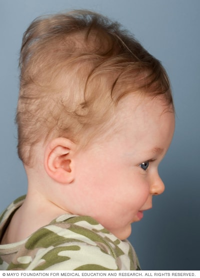 Babys head shape: Cause for concern? - Mayo Clinic