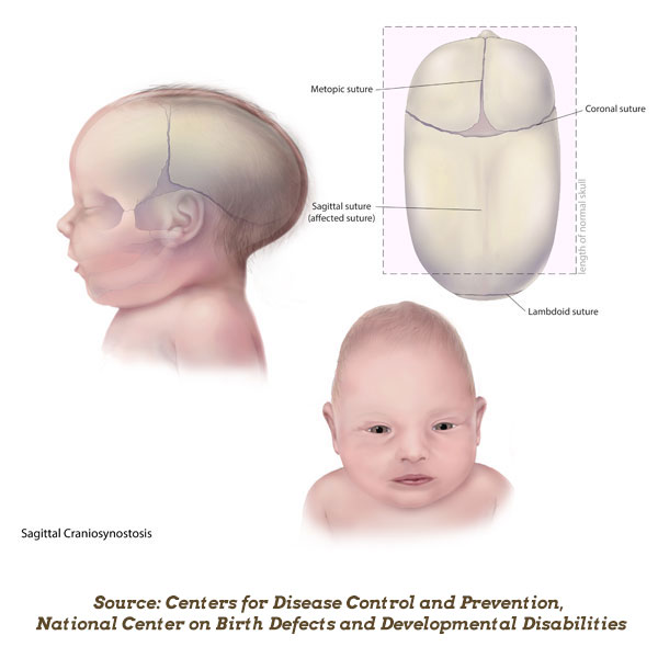 Uneven Head Shape in Babies: Causes and Treatment of ...