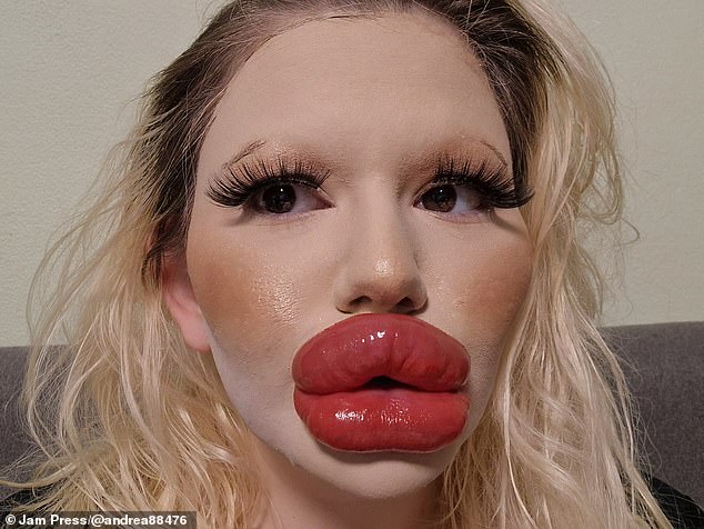 I have the worlds biggest lips but Ive had filler injected on ...