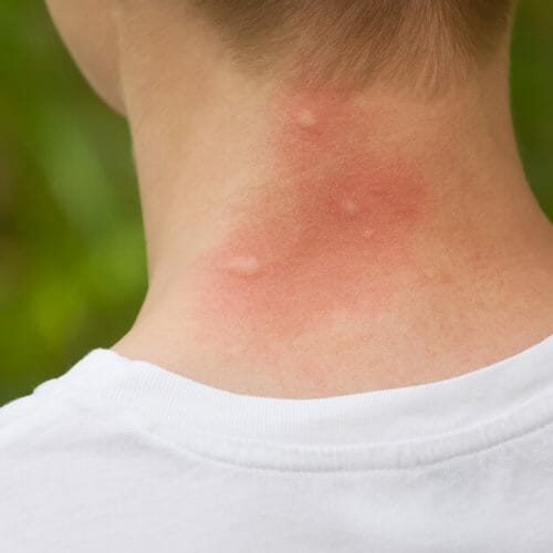 bites