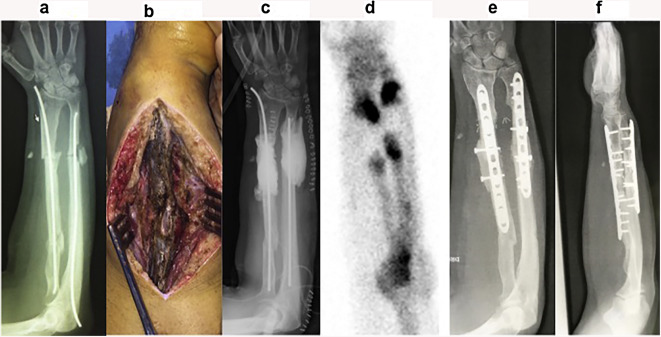 Black pigmentation of both forearm bones after chronic minocycline ...