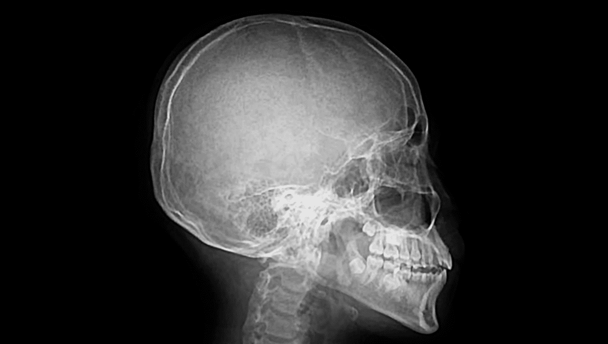 TikTokker Discovers At The Dentist That His Bones Have Turned ...