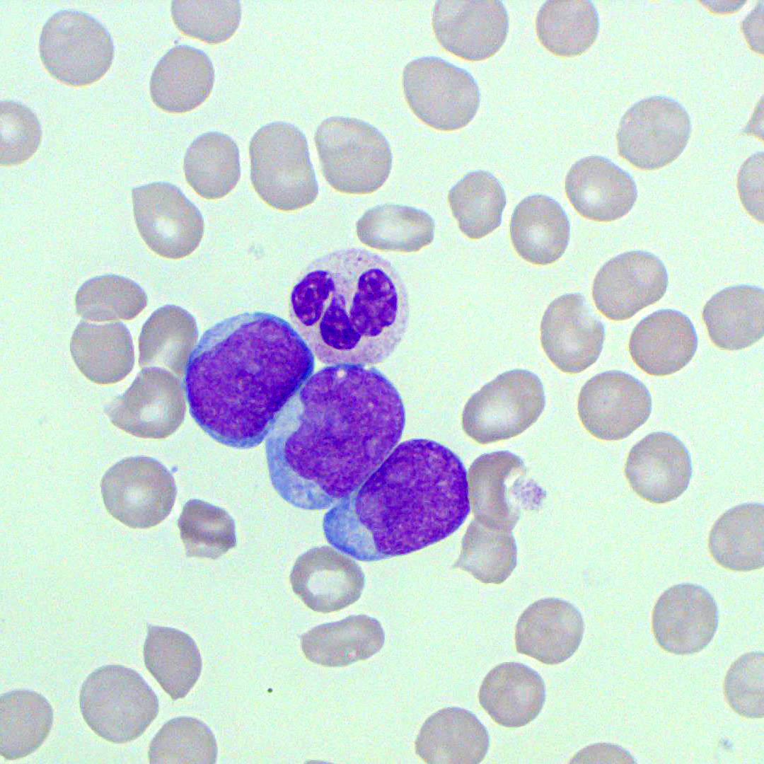 Circulating Blasts | Blood Film - MedSchool