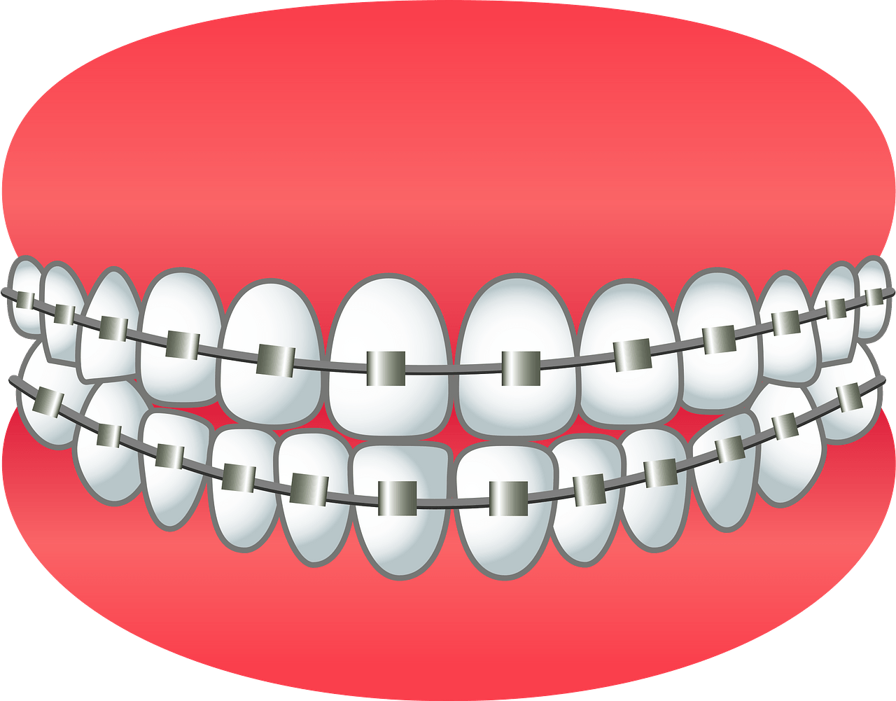 Dental Braces - Free vector clipart images on clipart library.com
