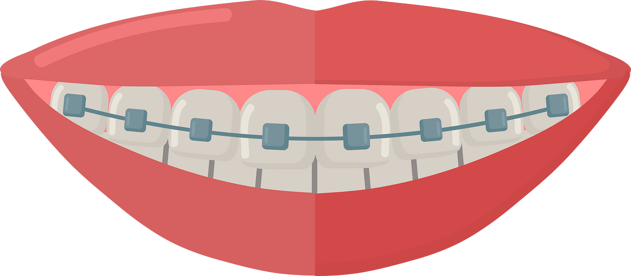 Smile with braces - Free vector clipart images on clipart library.com