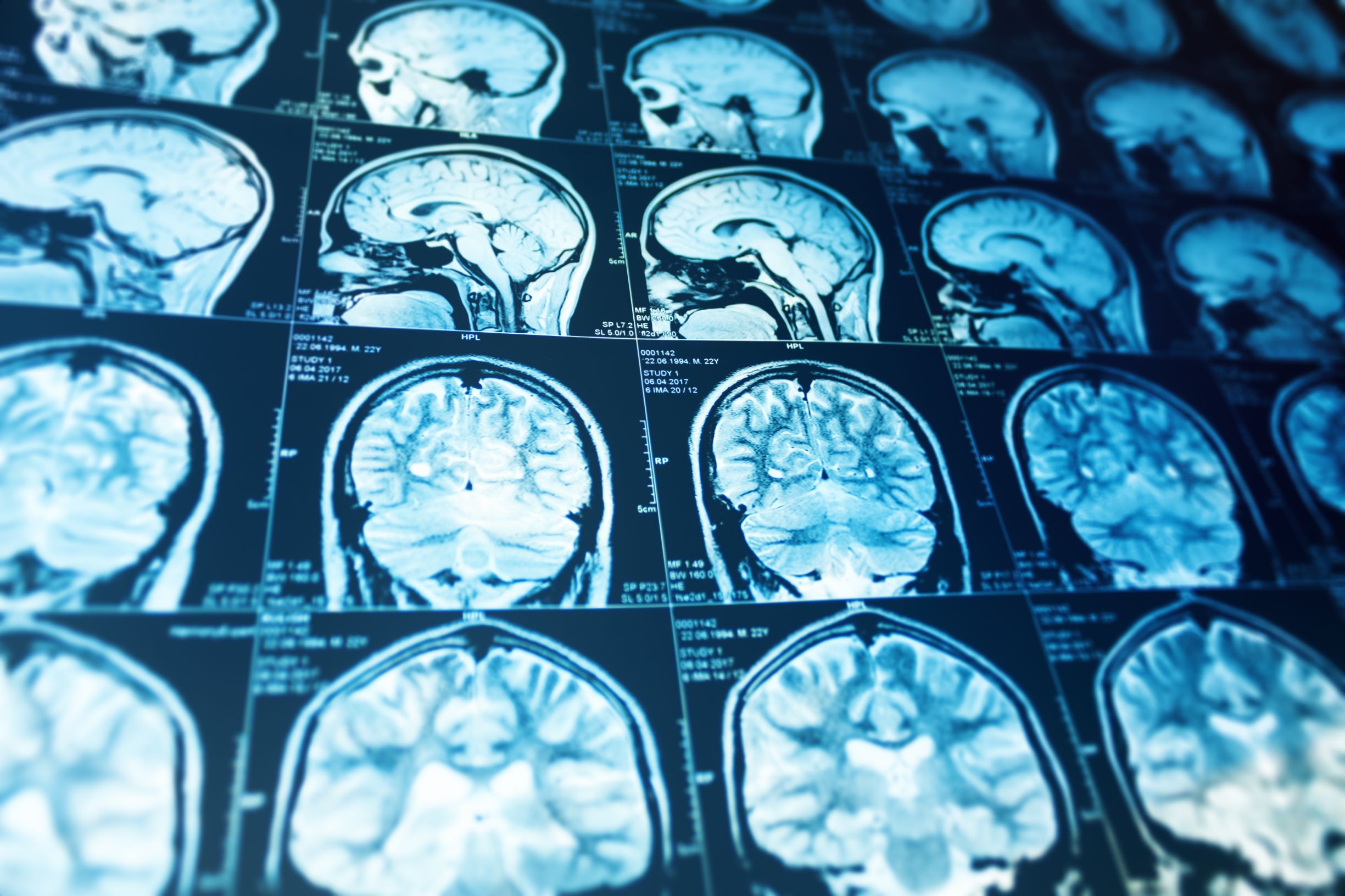 Too much TV may be bad for your long-term brain health | Live Science