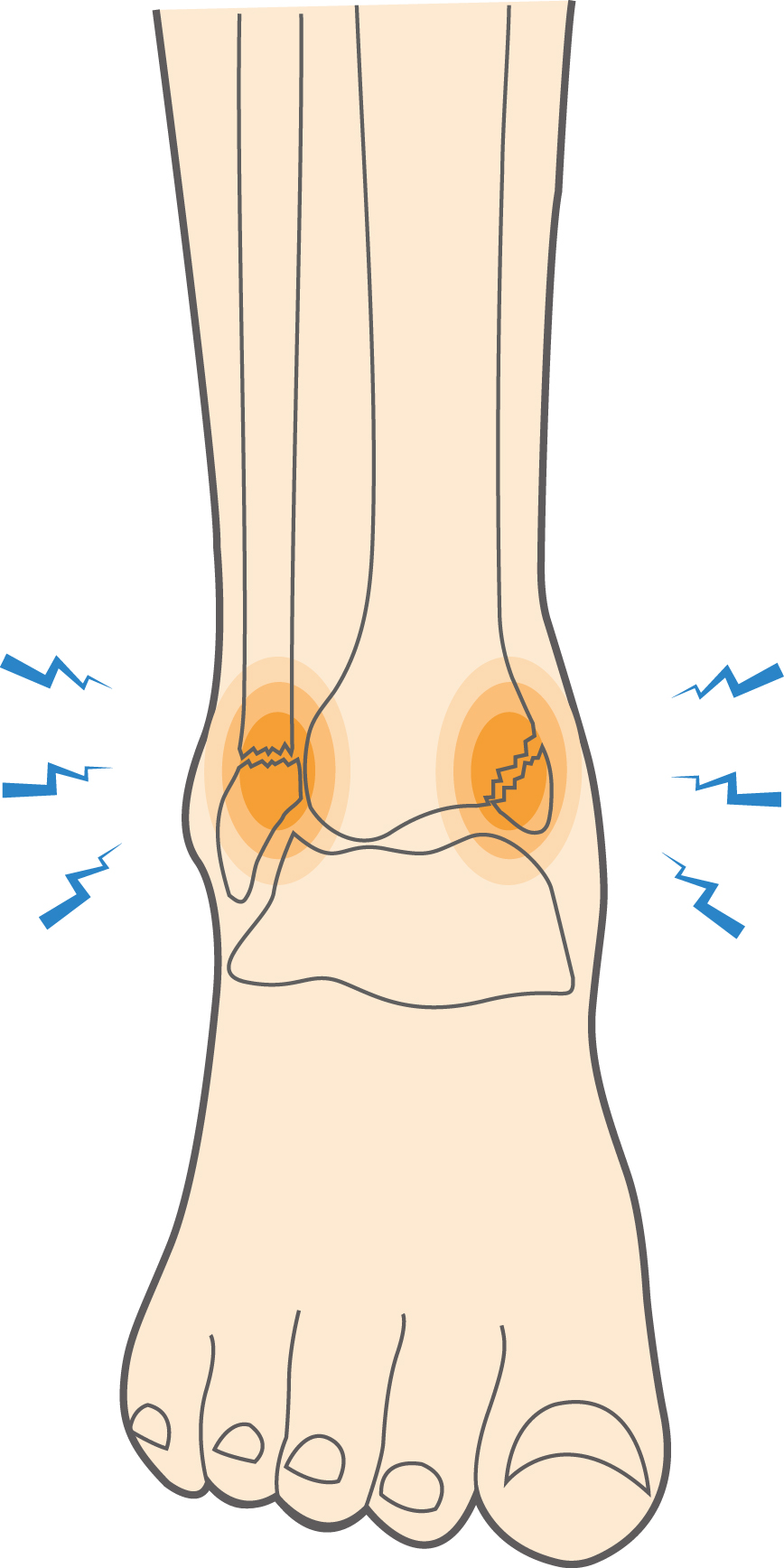 What are Ankle Fractures or Broken Ankle Injuries? - Upswing Health