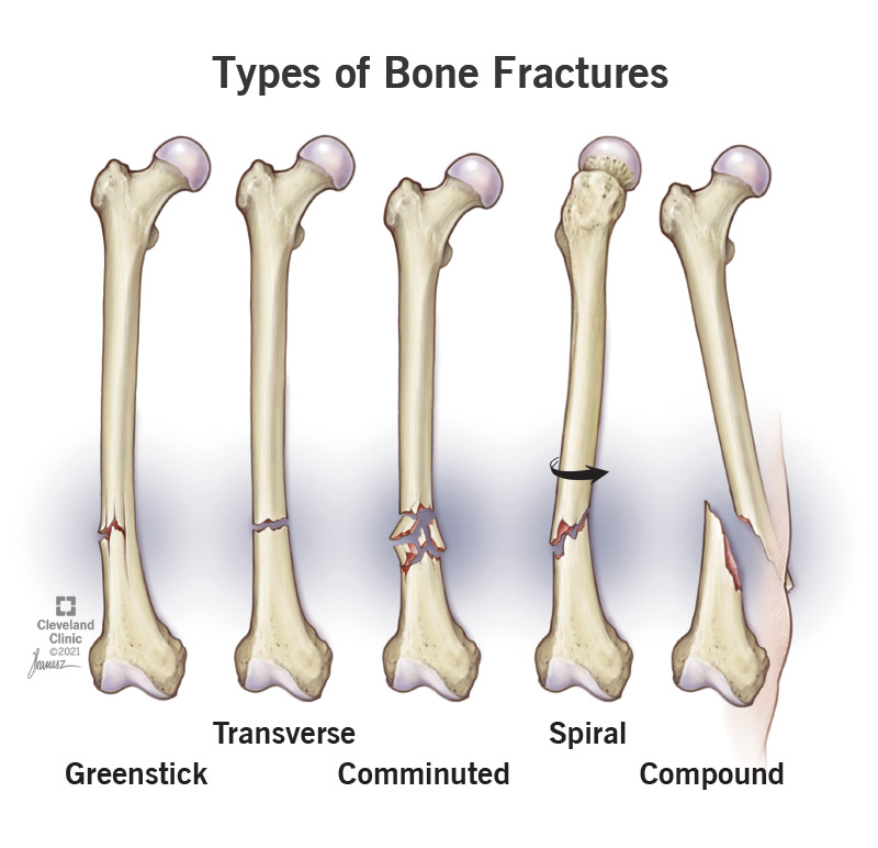 Bone Fractures: Types, Symptoms &amp; Treatment