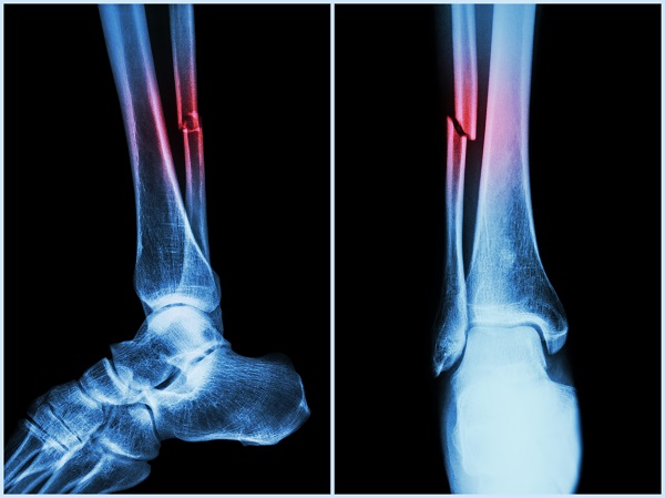 broken bones
