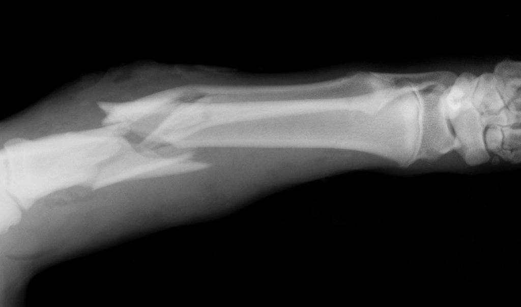 Diagnosis and Treatment for Broken Bones | Dr Santosh Shetty