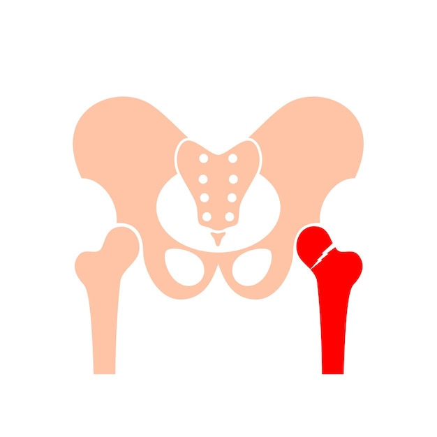 Premium Vector | Hip bone fracture poster Leg injury concept ...