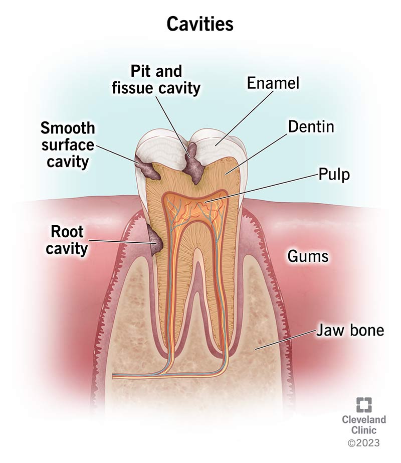 Cavities (Tooth Decay): Symptoms, Causes &amp; Treatment