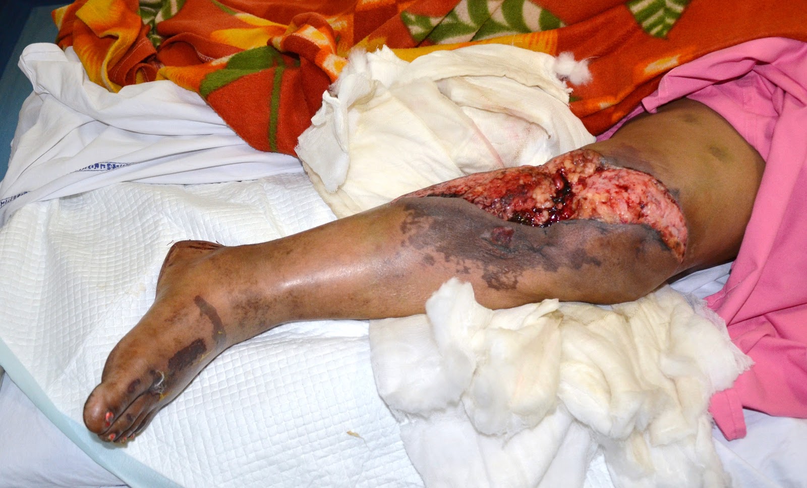 CRUSH INJURY FOOT, LOWER LIMB INJURIES AND LIMB SALVAGE: DEGLOVING ...