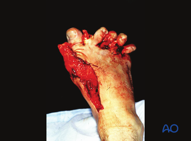 Crush injuries