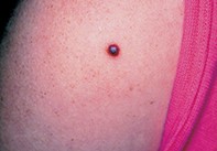 A dusky red papule | Medicine Today