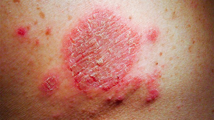 What Is Eczema? Symptoms, Causes, Diagnosis, Treatment, Prevention