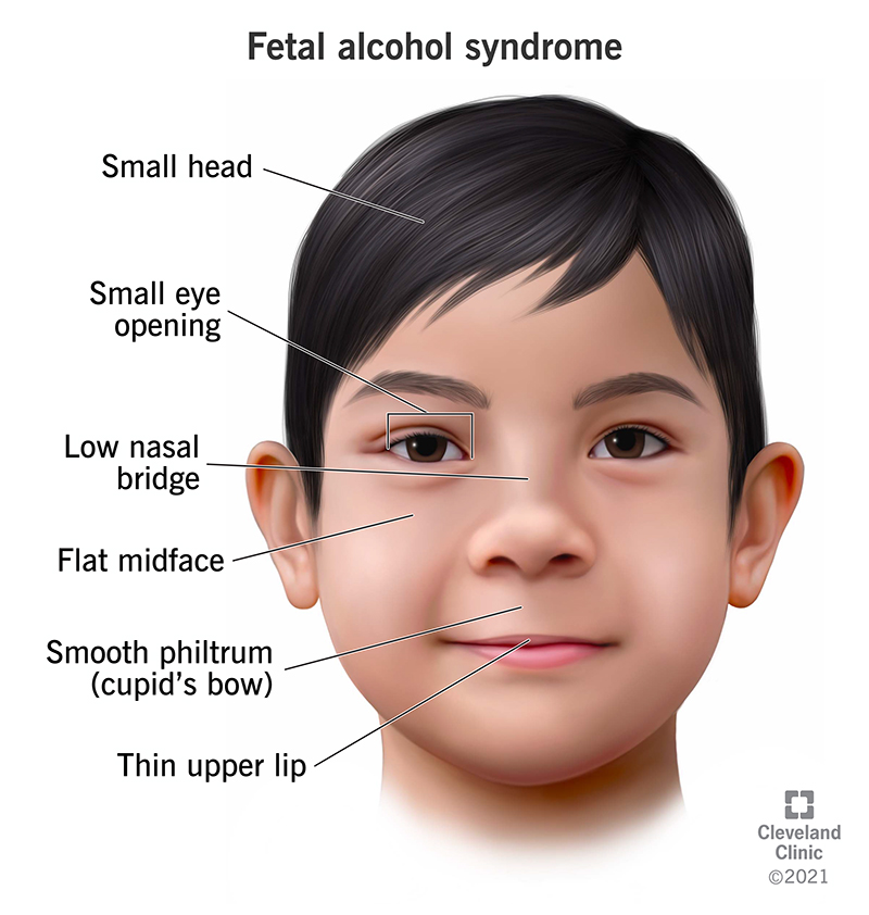 Fetal Alcohol Syndrome (FAS): Symptoms, Causes &amp; Treatment