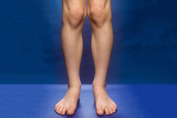 Knock knees - NHS