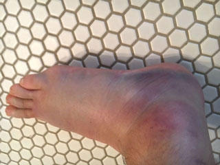 Leg Injury | | Ellicott City, MD | | Howard County Pediatrics
