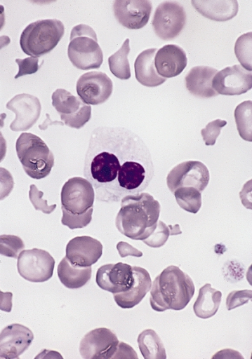 Myelodysplastic syndrome - Wikipedia