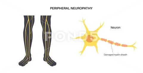 neuropathy cliparts
