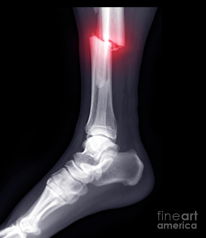 pic of broken leg