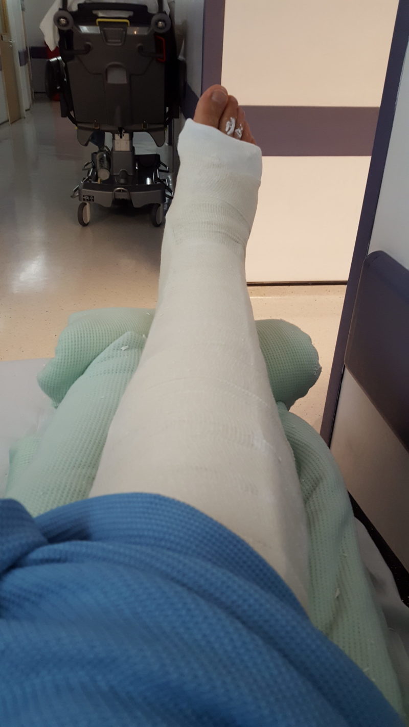 pic of broken leg
