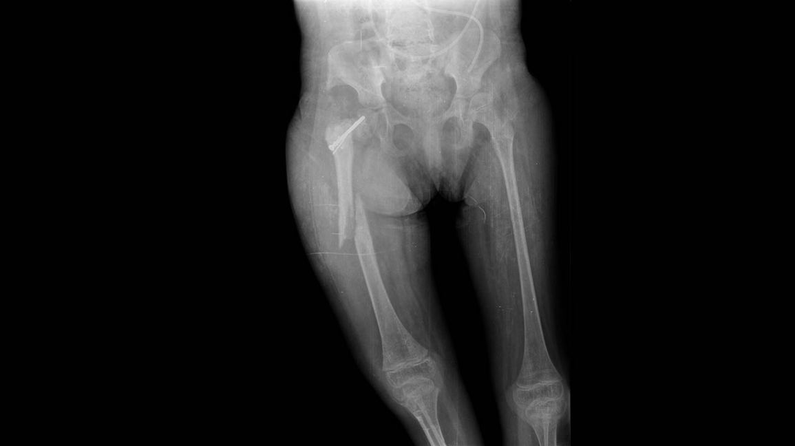 pic of broken leg