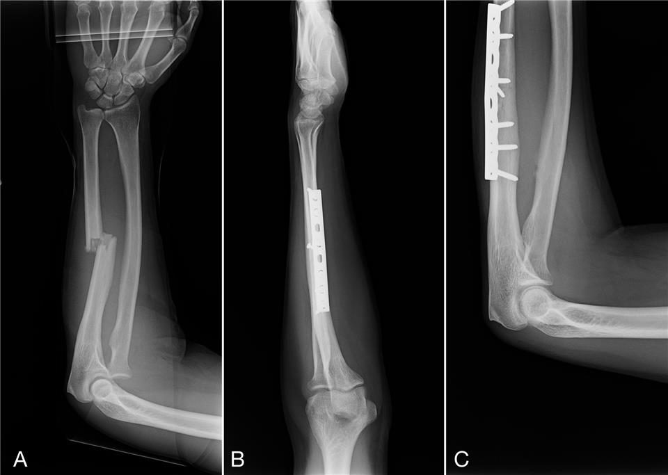 pics of broken arms