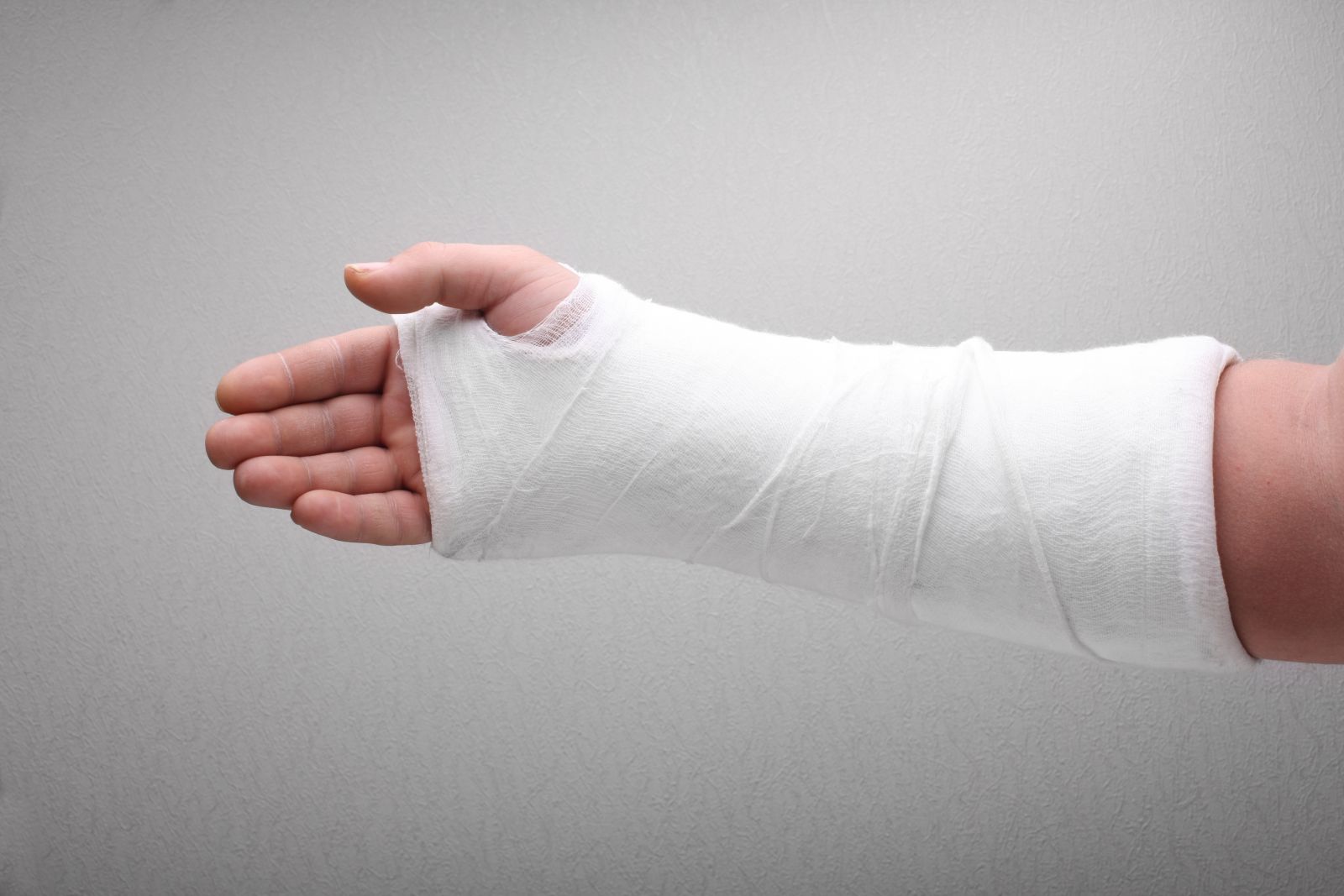 pics of broken arms