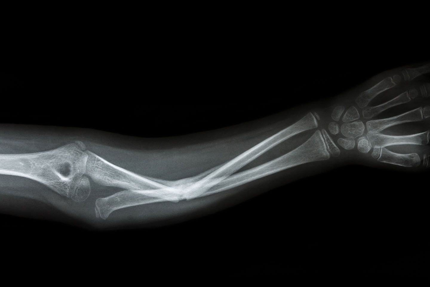 pics of broken arms